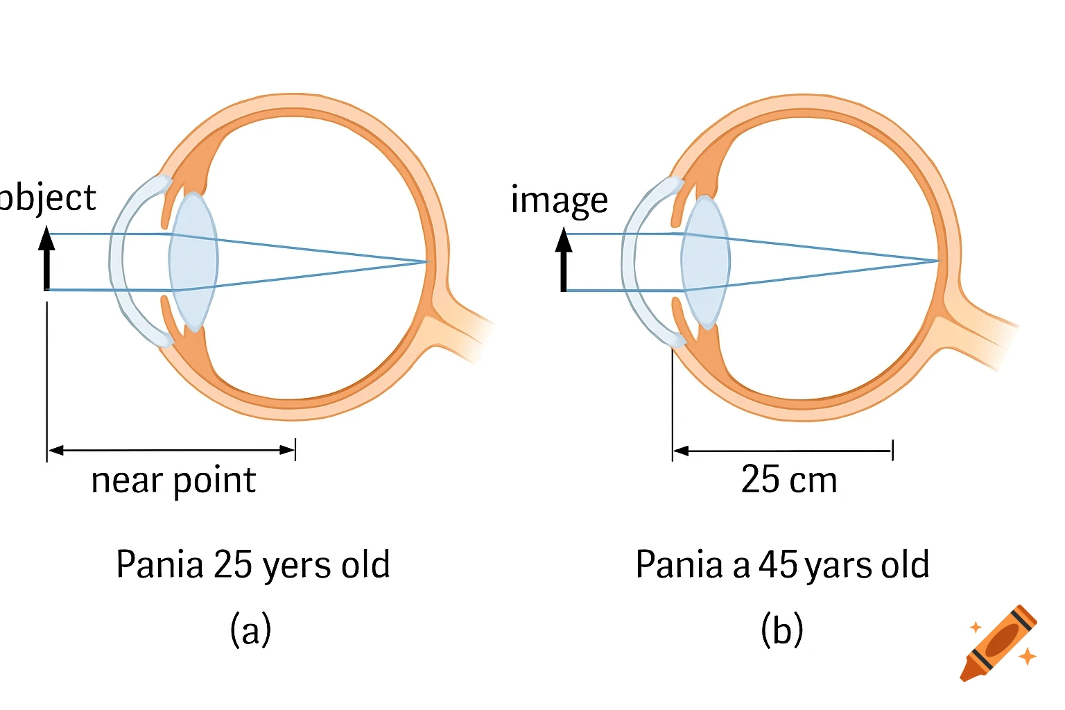Two diagrams of an eye showing image formation: one at the near point, one at 25 cm.