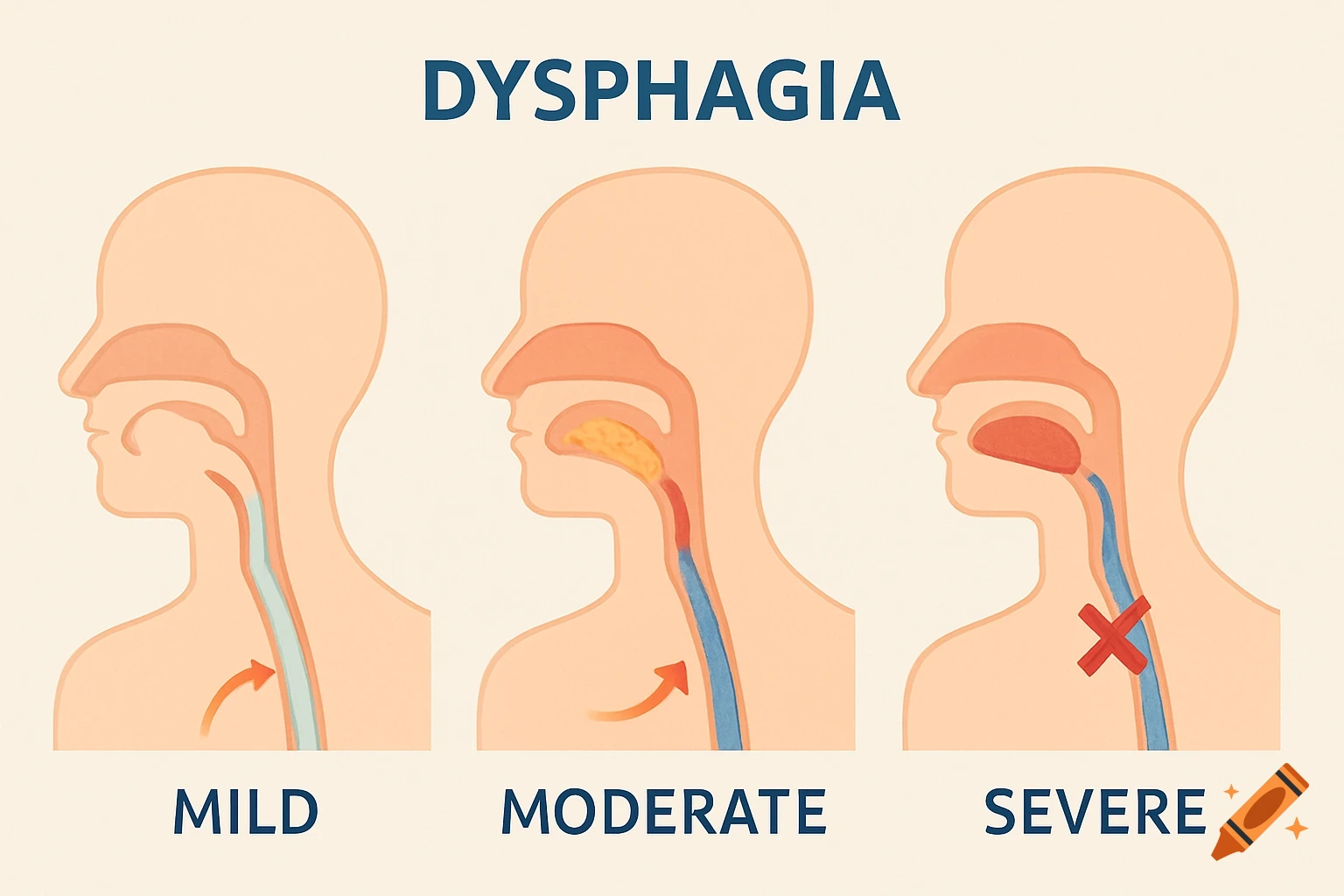 Medical illustration showing mild, moderate, and severe dysphagia in side profile diagrams of the head and neck.