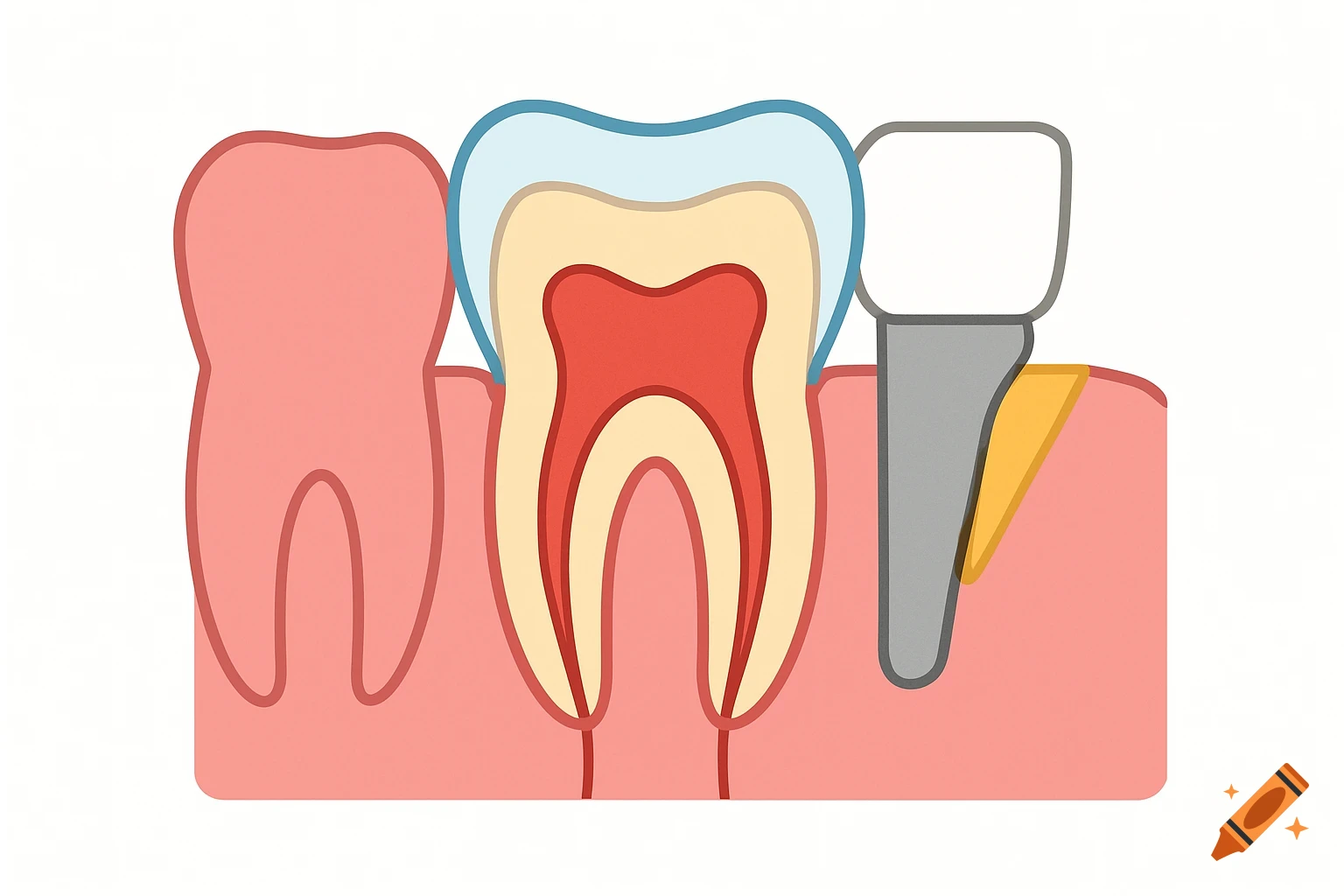 Flat 2D medical illustration of a tooth's internal structure and a dental implant with a crown in gum tissue.