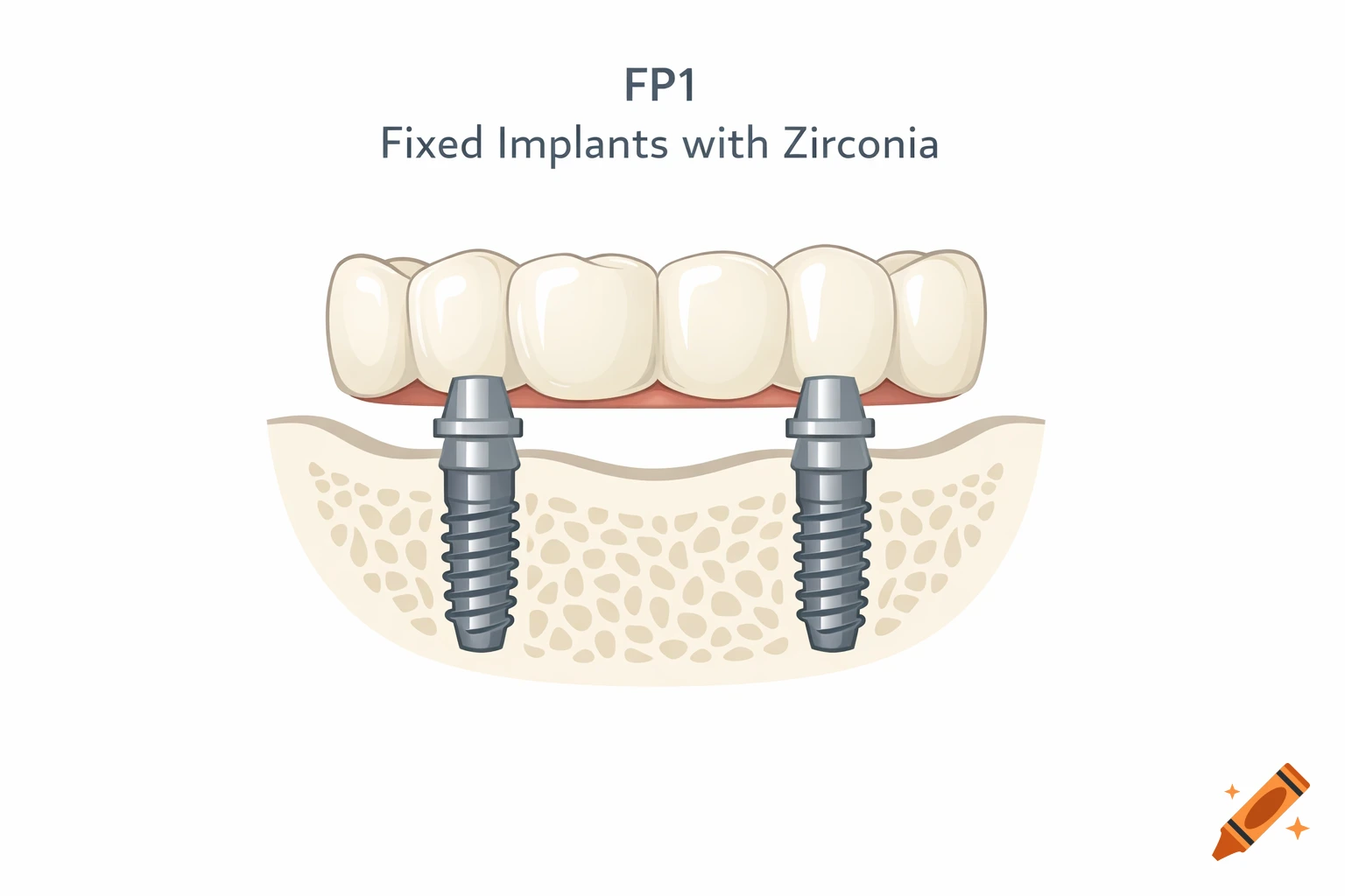Educational medical diagram of two dental implant posts in a jawbone supporting a fixed prosthesis, labeled 'FP1 Fixed Implants with Zirconia'.