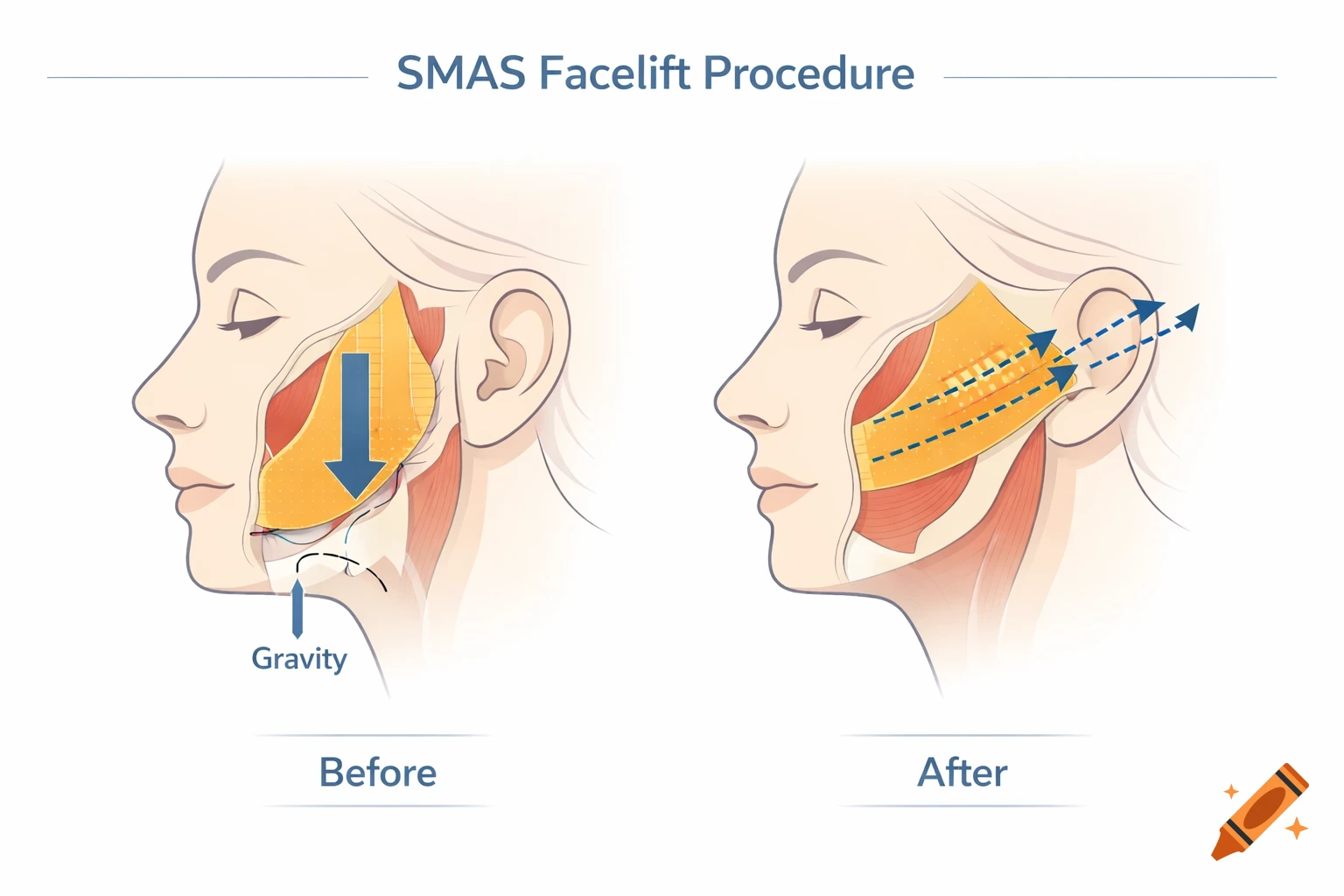 Medical diagram showing before and after SMAS facelift, illustrating gravity's effect and upward lifting on facial muscles.
