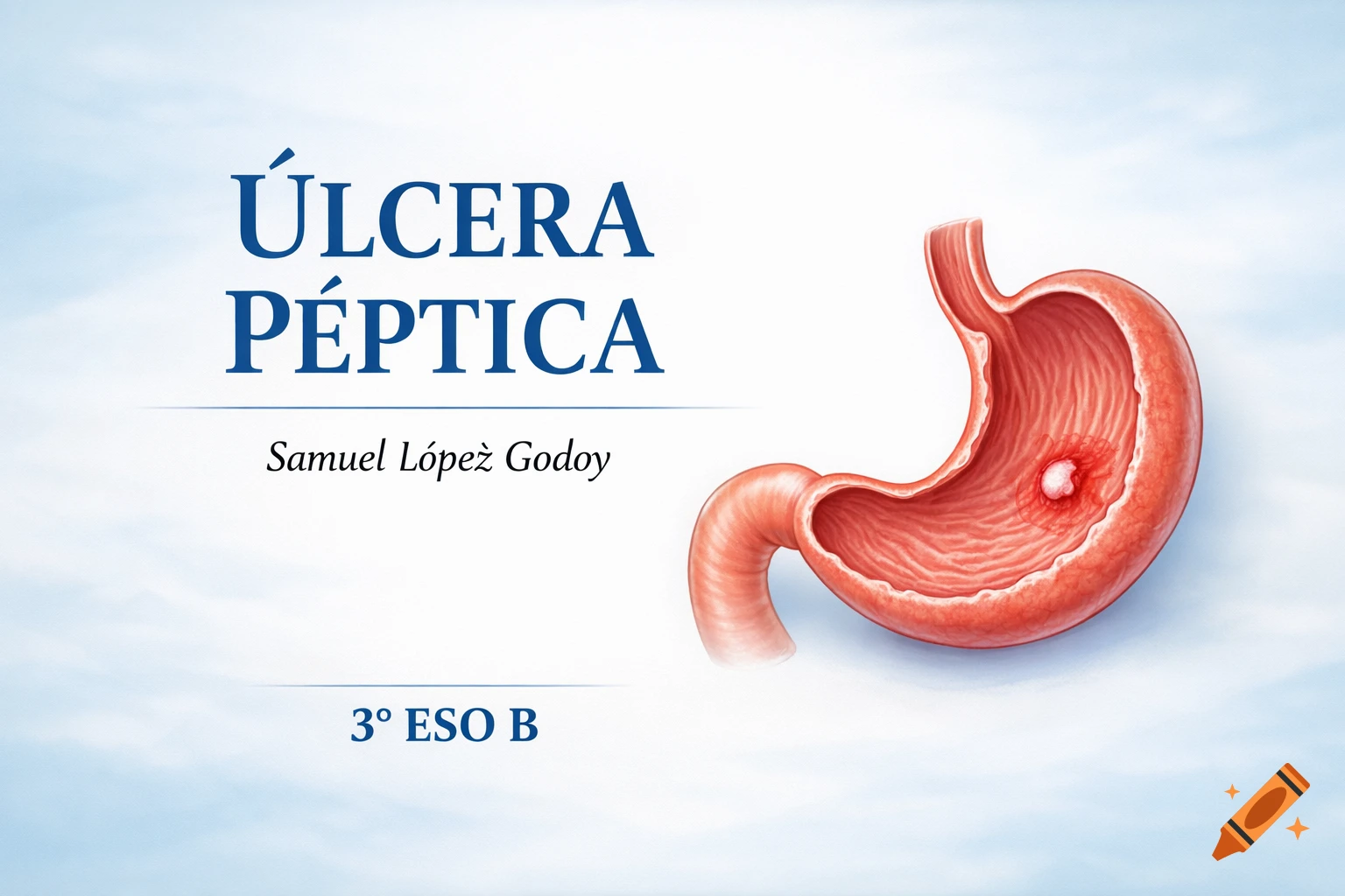 A clean, educational medical illustration of a human stomach showing a peptic ulcer. Text reads 'ÚLCERA PÉPTICA', 'Samuel López Godoy', and '3º ESO B' on a blue and white background.